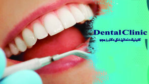 ونیر سرامیکی دندان یا کامپوزیتی