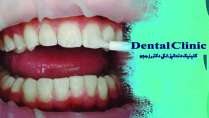 وارنیش فلوراید چیست