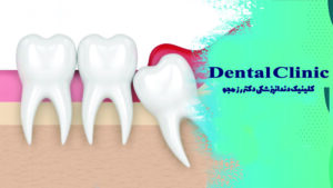 ورم لثه دندان عقل