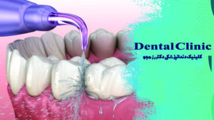 واتر جت دندان چیست