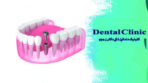 هیلینگ ایمپلنت چیست