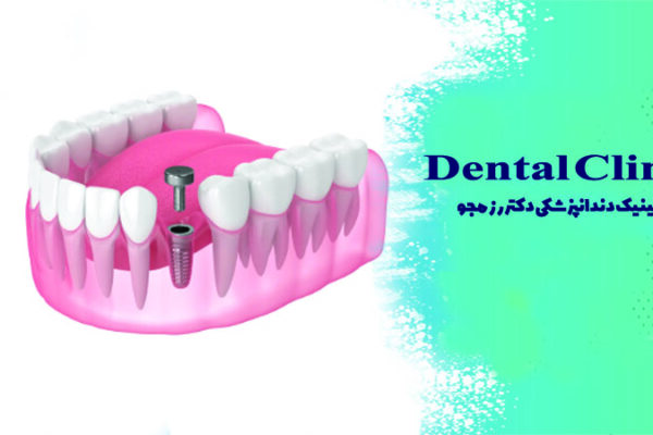 هیلینگ ایمپلنت چیست