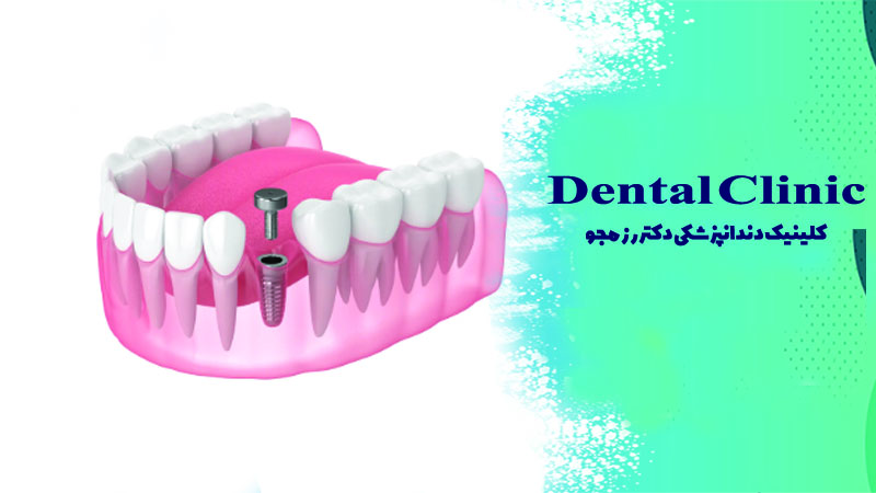 هیلینگ ایمپلنت چیست