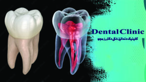 دندان چند کانال عصبی دارد