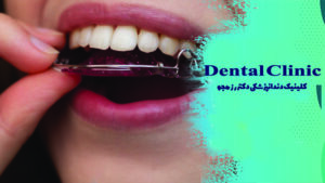 نگهدارنده ارتودنسی چیست