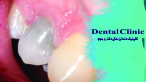 نکروز دندان چیست؟