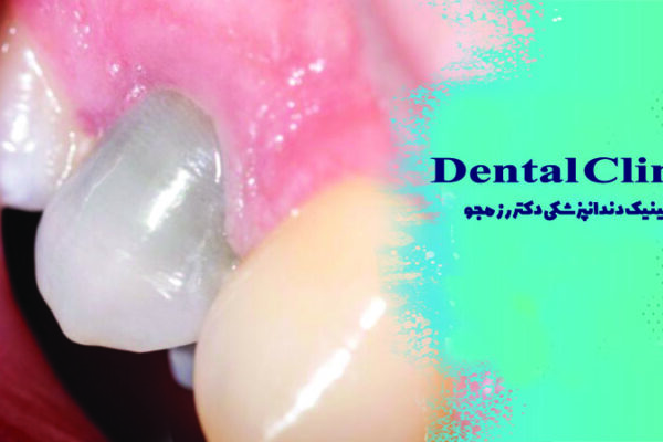 نکروز دندان چیست؟