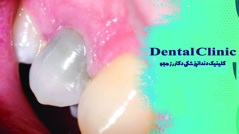 نکروز دندان چیست؟