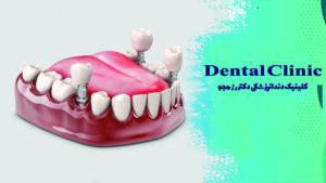 نکات مهم بعد از ایمپلنت دندان