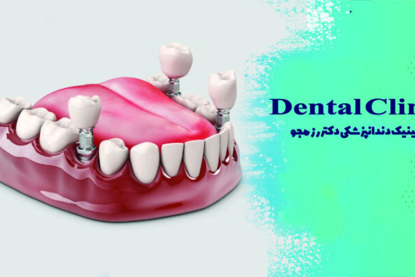 نکات مهم بعد از ایمپلنت دندان