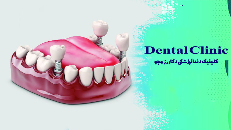 نکات مهم بعد از ایمپلنت دندان