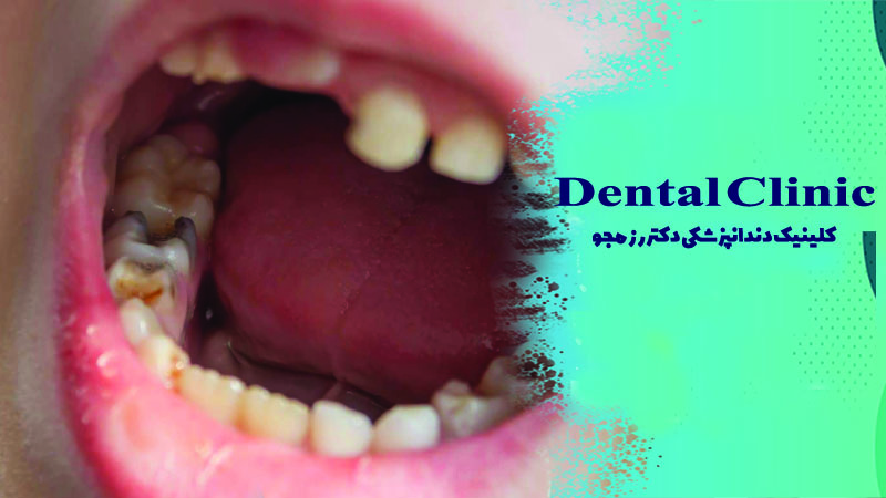 علائم عفونت دندان