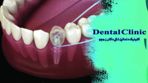 نخ دندان مخصوص ایمپلنت