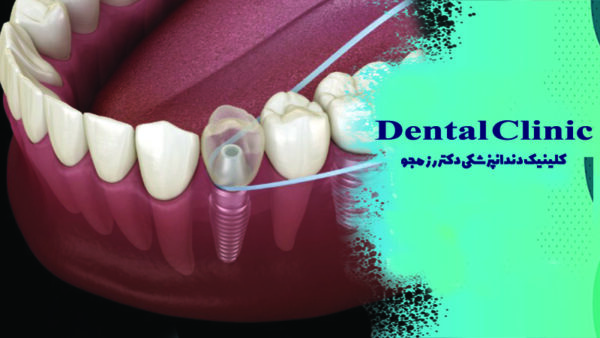 نخ دندان مخصوص ایمپلنت