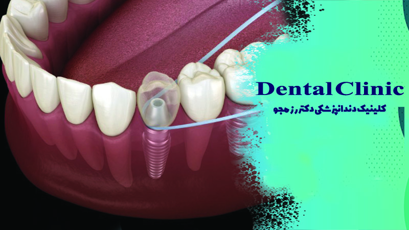 نخ دندان مخصوص ایمپلنت