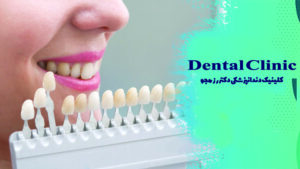 نحوه گذاشتن لمینت دندان