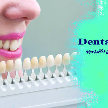 نحوه گذاشتن لمینت دندان