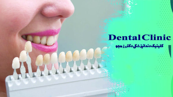 نحوه گذاشتن لمینت دندان