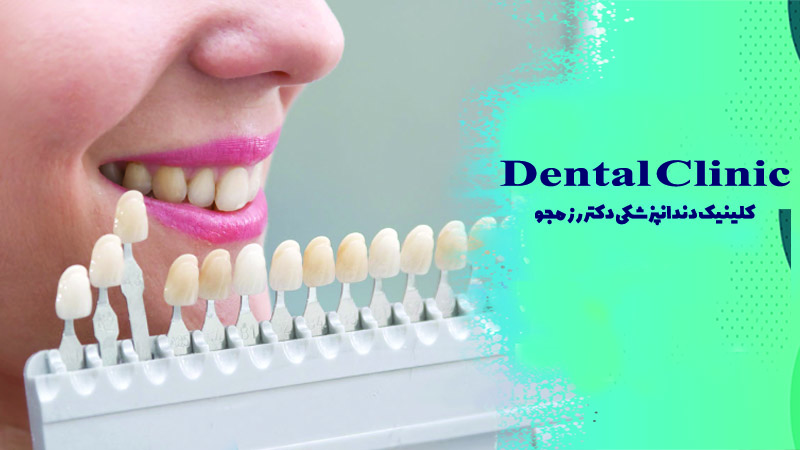 نحوه گذاشتن لمینت دندان