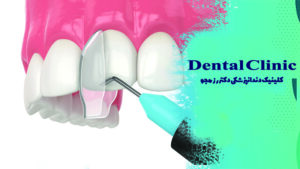 مراحل کامپوزیت کردن دندان