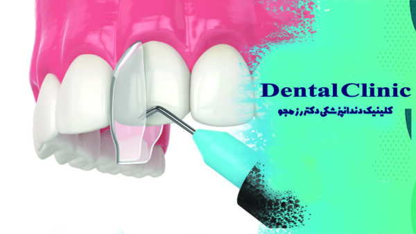 مراحل کامپوزیت کردن دندان