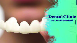 نحوه قالب گیری اسنپ اسمایل