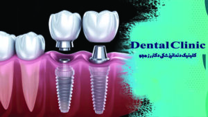 ساخت روکش ایمپلنت