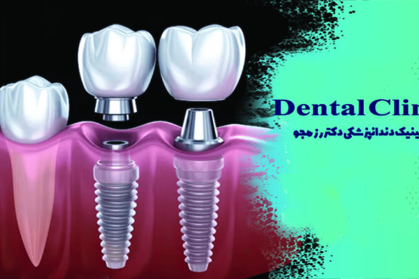 ساخت روکش ایمپلنت