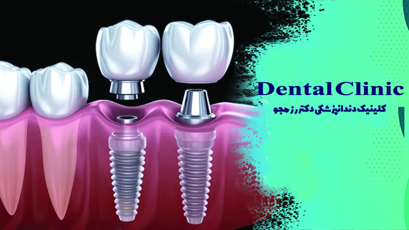 ساخت روکش ایمپلنت