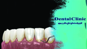 جرم گیری دندان (بروساژ) چیست؟