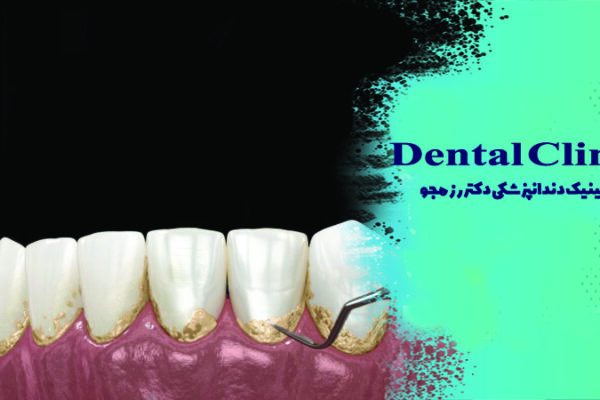 جرم گیری دندان (بروساژ) چیست؟