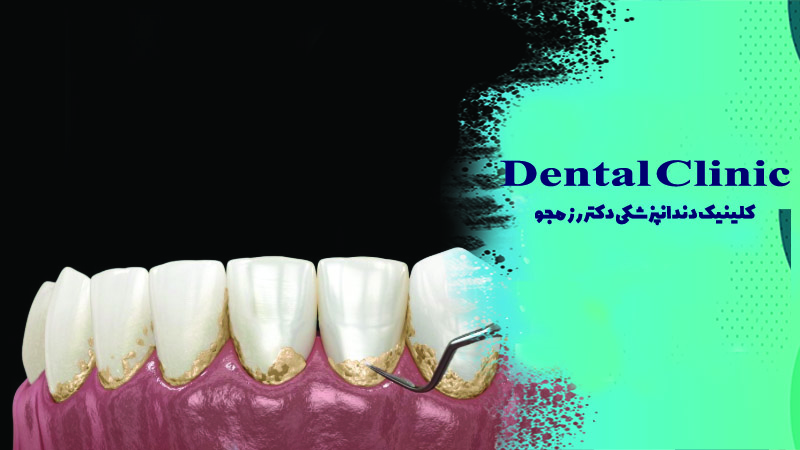 جرم گیری دندان (بروساژ) چیست؟