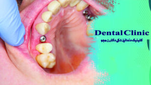 عفونت بعد از ایمپلنت دندان