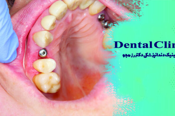 عفونت بعد از ایمپلنت دندان
