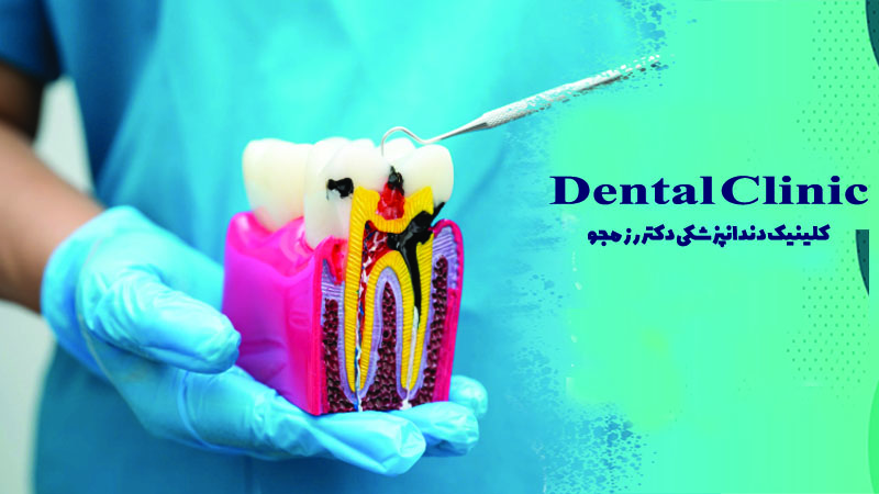 درمان پوسیدگی عمیق دندان