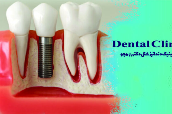 چند نوع ایمپلنت