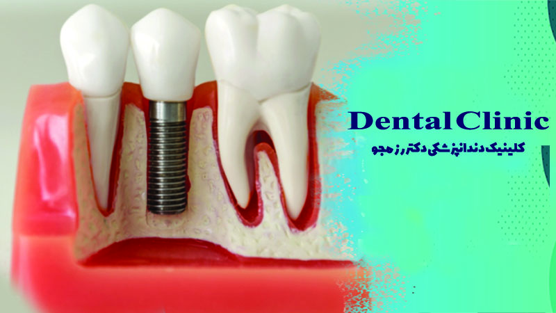 چند نوع ایمپلنت