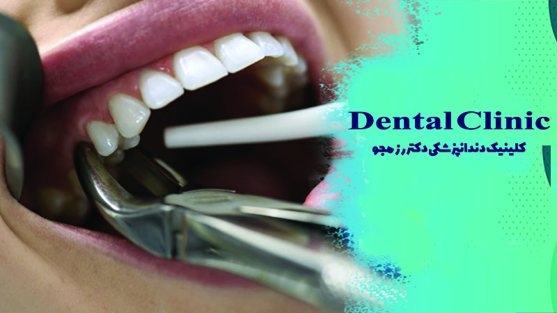 کنترل خونریزی بعد از کشیدن دندان