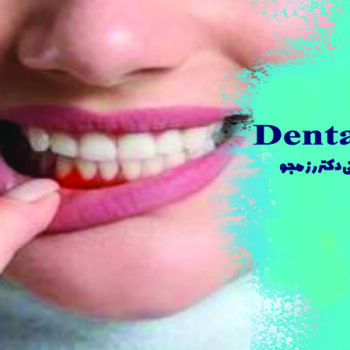 بیماری لثه (پریودنتیت)
