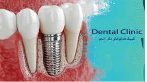 ایمپلنت دندان