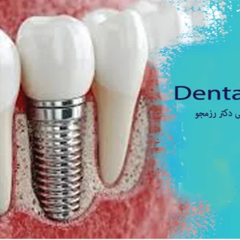 ایمپلنت دندان