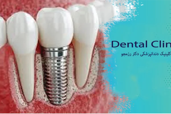 ایمپلنت دندان
