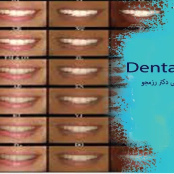 بهترین رنگ کامپوزیت دندان