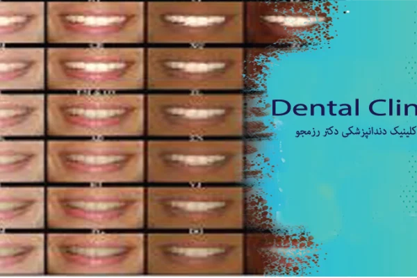 بهترین رنگ کامپوزیت دندان