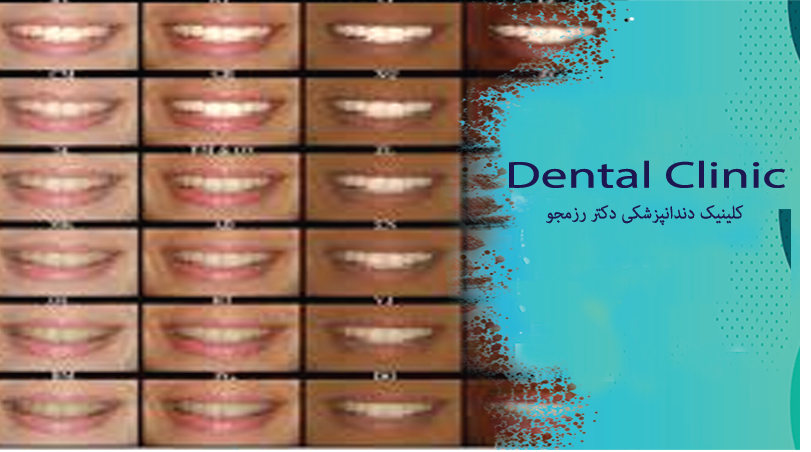 بهترین رنگ کامپوزیت دندان