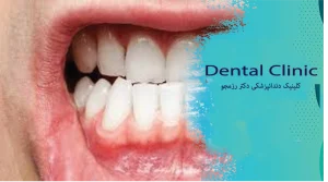 سلامت لثه برای بزرگسالان