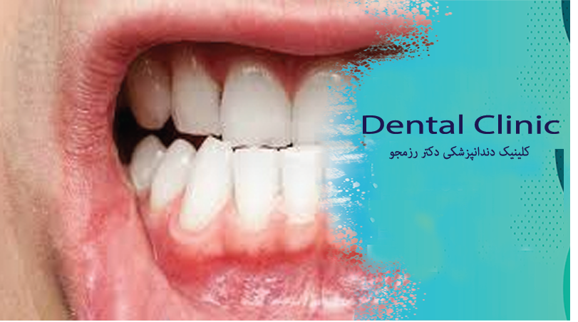 سلامت لثه برای بزرگسالان