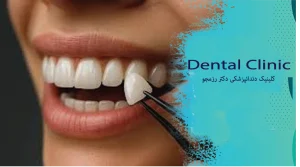ماندگاری لمینت دندان