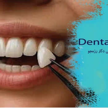 ماندگاری لمینت دندان