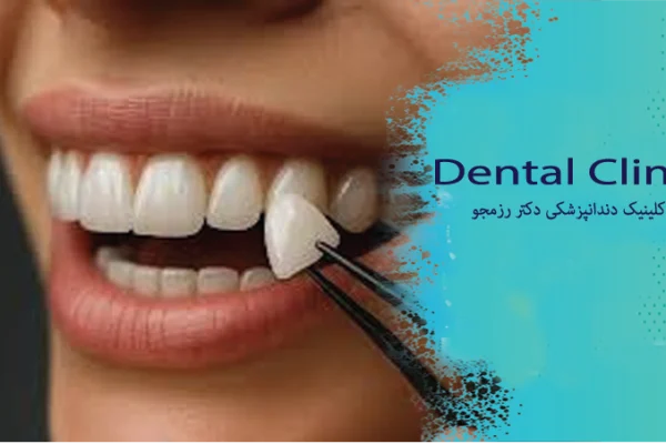 ماندگاری لمینت دندان